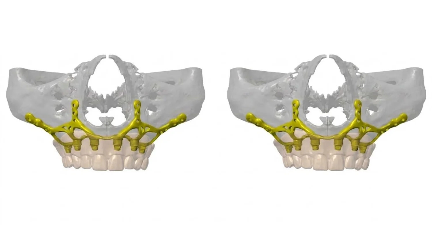 Subperiosteal Implants for Maxillary Reconstruction 2